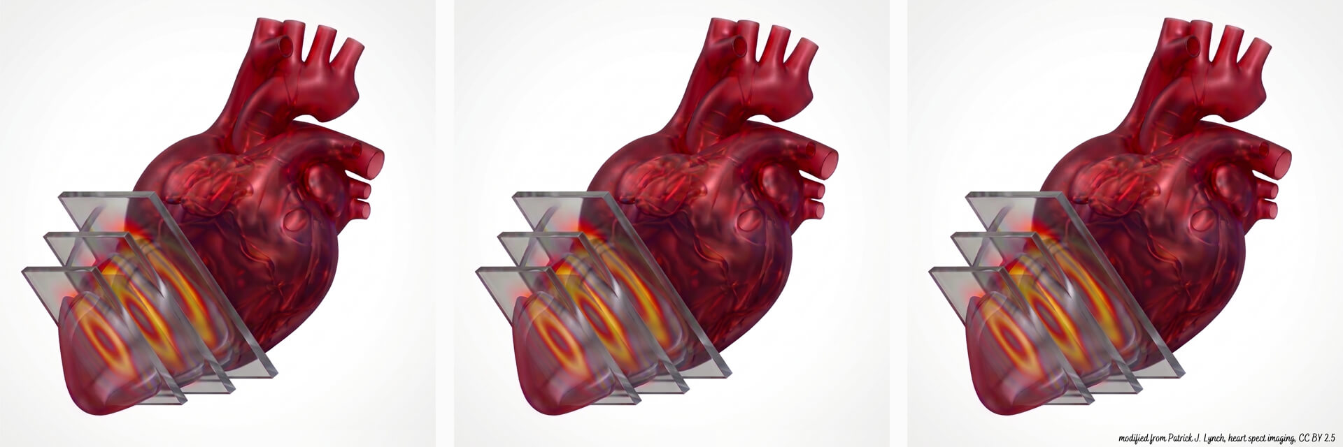 3D-Modell eines menschlichen Herzens, das mit Querschnitten einer nuklearmedizinischen SPECT-Untersuchung (Single-Photon-Emission-Computed-Tomography) kombiniert ist